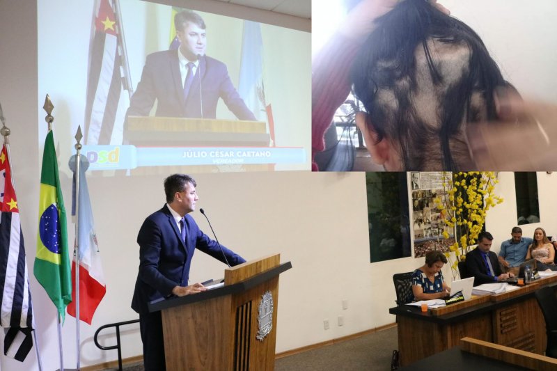 Câmara aprova projeto para conscientização sobre alopecia areata