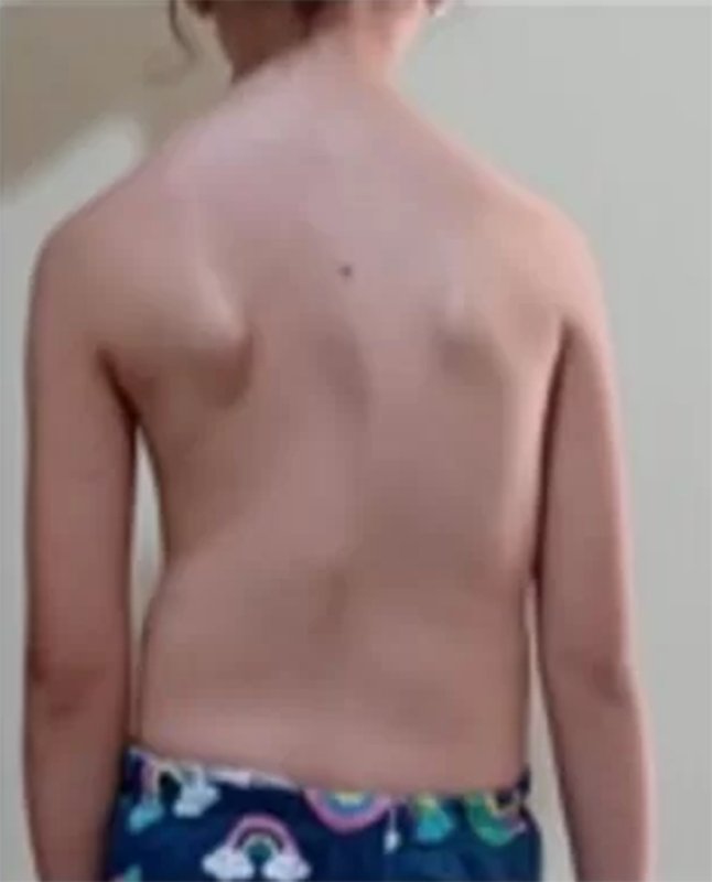 Menina de 7 anos precisa de colete para a coluna; família faz vaquinha