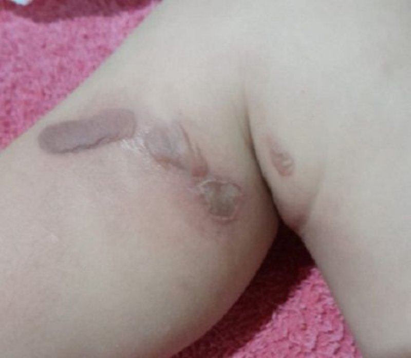 Mãe denuncia creche após bebê aparecer com queimaduras na perna e partes íntimas, em Votuporanga