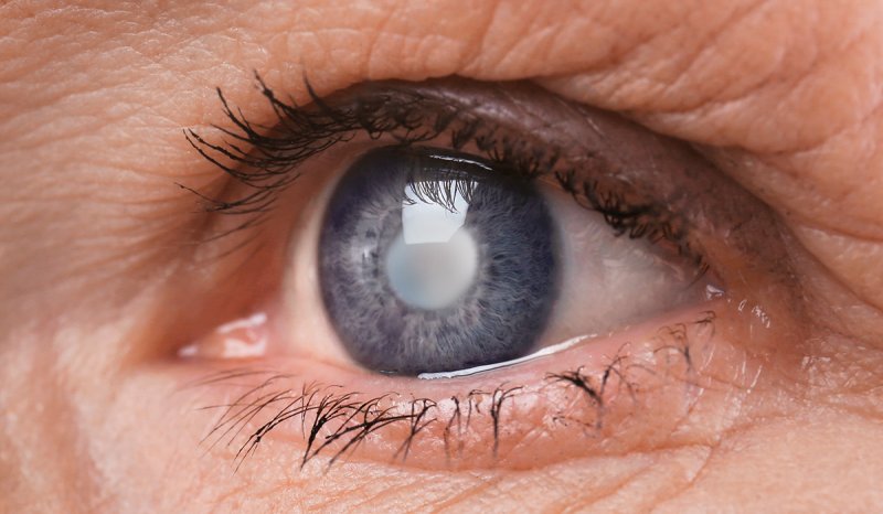 Catarata e glaucoma são as principais doenças oculares