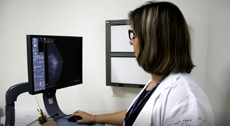 Entidades médicas pedem faixa etária maior para mamografia de rastreio