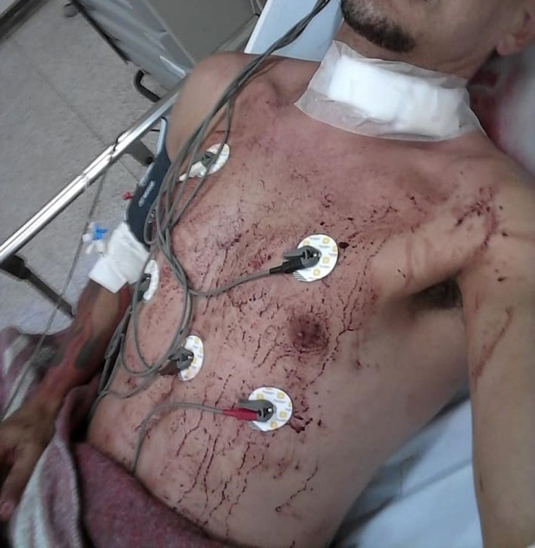 Motociclista tem pescoço cortado por linha com cerol